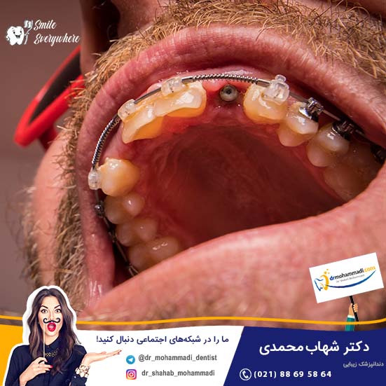 آیا ایمپلنت دندان به ارتودنسی آسیب می زند؟ - کلینیک دندانپزشکی دکتر شهاب محمدی